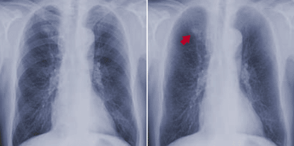 Image: Comparison of a standard digital X-ray (left) and SoftView images (right) when visualizing a lung nodule. SoftView increases the clarity of chest X-rays by suppressing bone on the digital image (Photo courtesy of Riverain Medical).